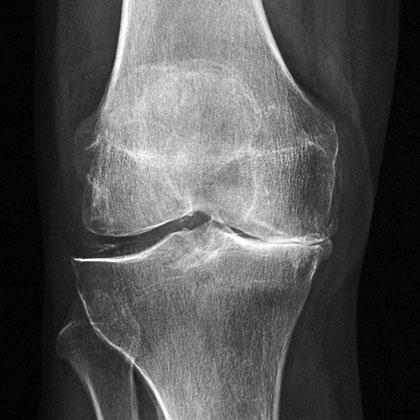 Arthritis: 6 Common Myths That May Be Holding You Back